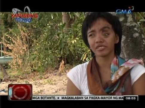 Ginang na may bukol sa mukha, matagumpay na naoperahan