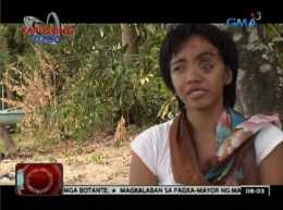 Ginang na may bukol sa mukha, matagumpay na naoperahan