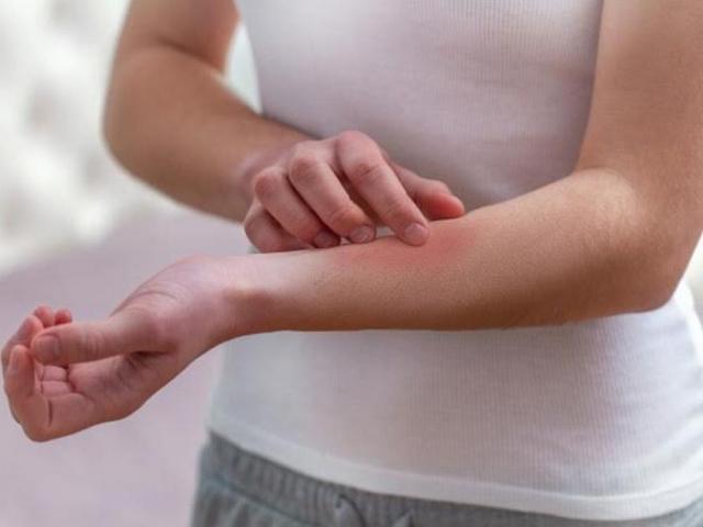 Woman scratching the skin