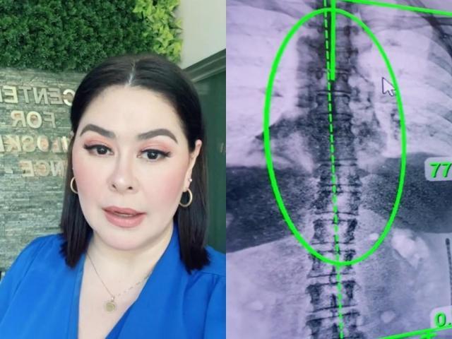 Connie Sison, Scoliosis