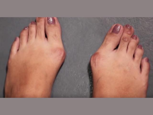 How to prevent bunions
