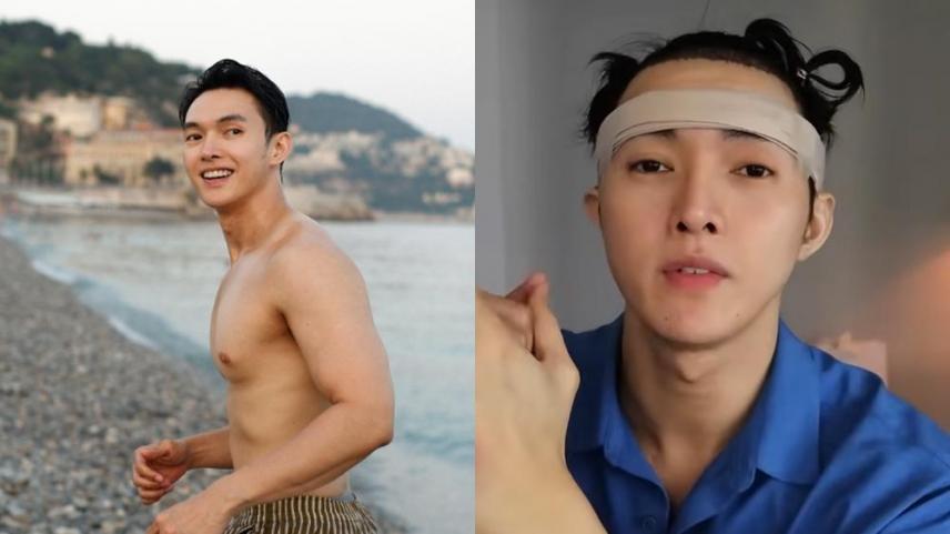 Lharby Policarpio hair transplant