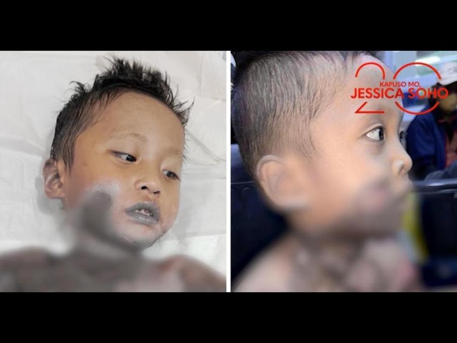 Bataong nalapnos ang balat KMJS