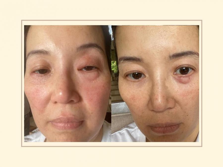 Kris Aquino shows "bad allergic reaction" after drinking wrong medicines |  GMA Entertainment