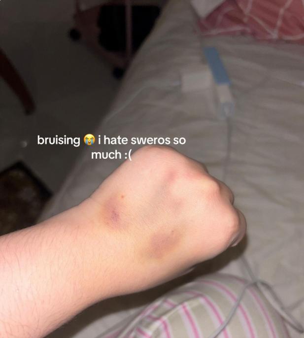 Bruises