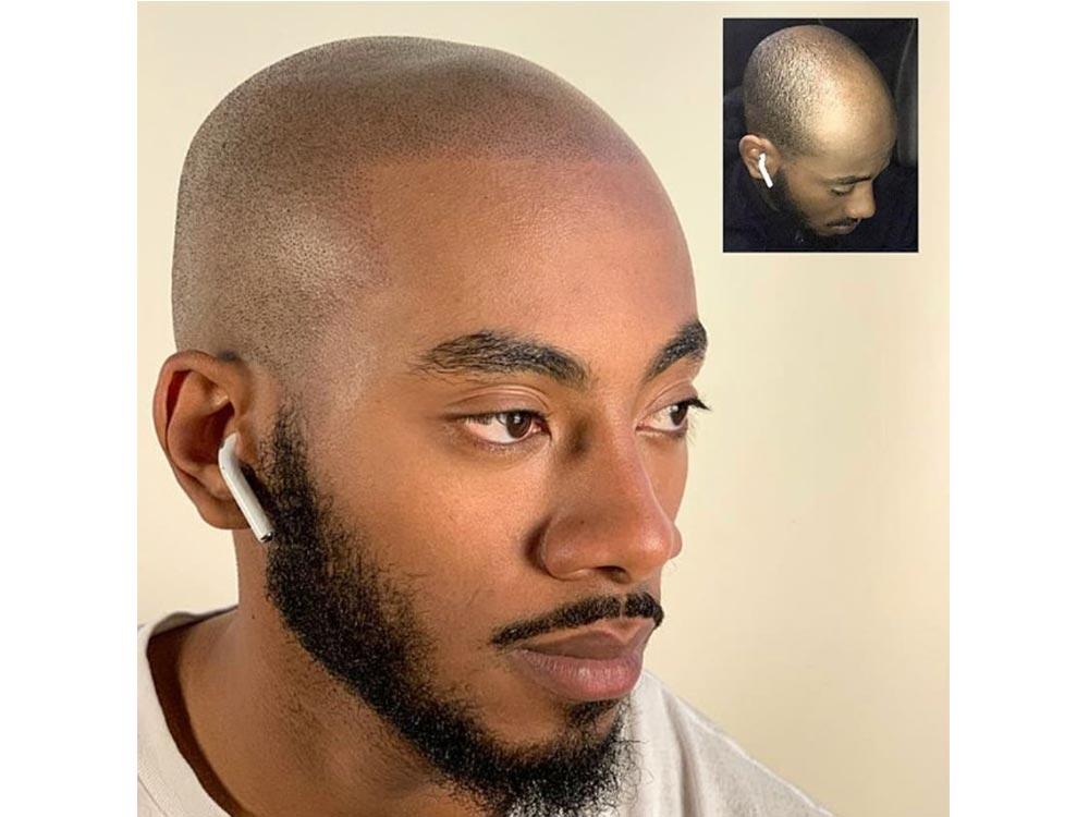 Scalp Hyperpigmentation