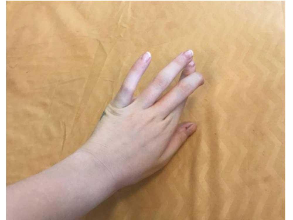 Ringless finger