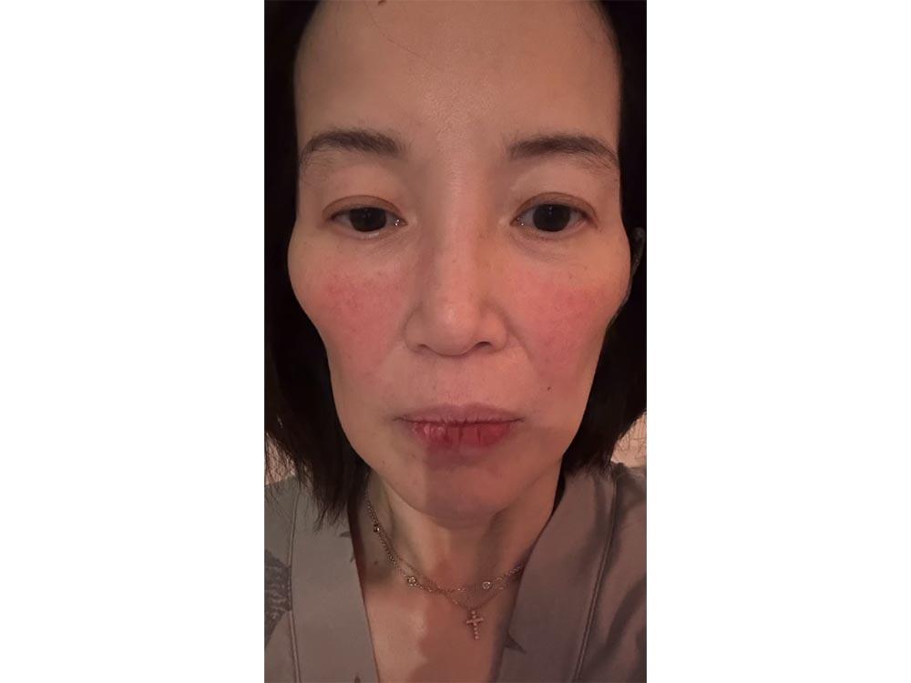 Fifth autoimmune illness