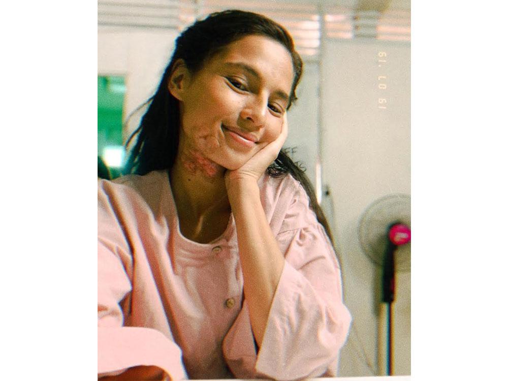 Jasmine in prosthetics