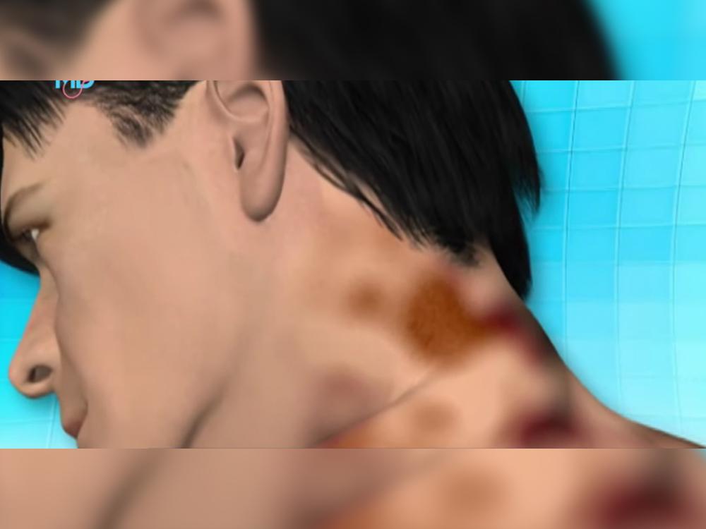 'Choco na batok' could be symptom of underlying medical condition