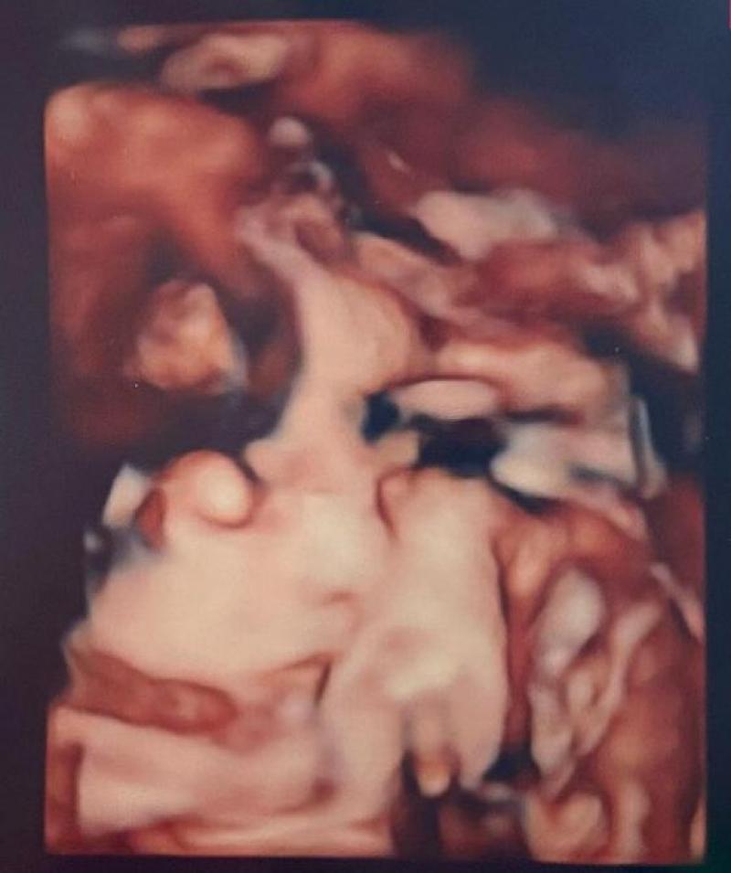 Joyce Pring ultrasound