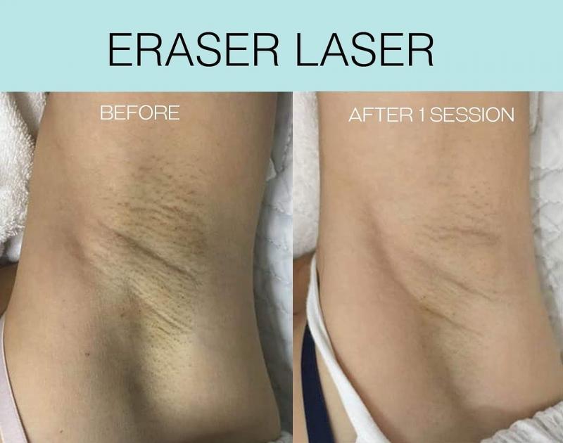 Best Laser Hair Removal Prices/Costs in Toronto | Laser4Less | From $50